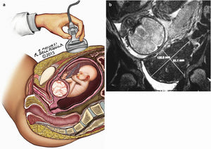 Fibroids and Pregnancy